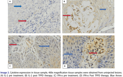 Impact of intralesional tuberculin PPD injectionon anogenital warts: Interferon-α, interleukin-2,and treatment outcomes