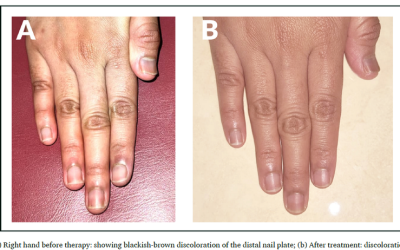 Successful treatment of rare non-dermatophyte onychomycosis caused by Chaetomium spp. with oral fluconazole and topical terbinafine combination – A case report from Indonesia and literature review