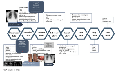 A rare case of unusual anti-tuberculosisdrug reaction in disseminated tuberculosiswith pre-existing Multisystem Inflammatory Syndrome in Children (MIS-C)