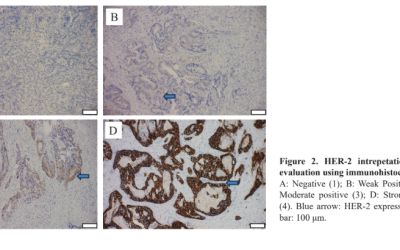 Combined COX-2 and HER-2 Biomarker Profiling to Predict NeoadjuvantChemoradiotherapy Response in Locally Advanced Rectal Cancer