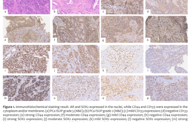 SOX2 expression in the primary tumor of castration-naive metastatic prostate adenocarcinoma in association with metastasis extent