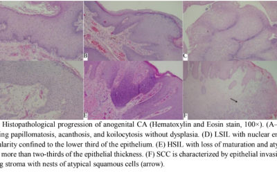 Histopathological Progression and Clinicopathologic Factors Associated with Anogenital Condyloma Acuminata: A Pathological Perspective From a Tertiary Hospital in Indonesia