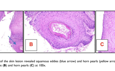 Inverted Follicular Keratosis in Young Adult: A Rare Entity in the Differential Diagnosis of SkinTumors