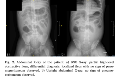 Managing concurrent nephrotic syndrome, spontaneous bacterial peritonitis, and herpes zoster in an immunocompromised child: Diagnostic difficulties and treatment outcomes