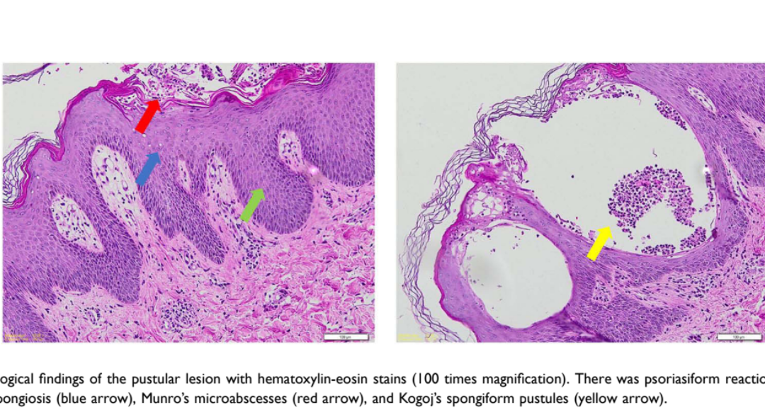 The Uncommon Coexistence of Mid-Borderline Leprosy and Generalized Pustular Psoriasis