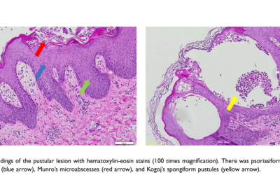 The Uncommon Coexistence of Mid-Borderline Leprosy and Generalized Pustular Psoriasis