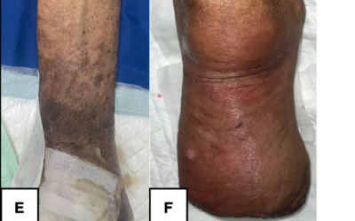 Treatment neglect in multibacillary leprosy leading to osteomyelitis and transtibial amputation: Lessons from endemic setting